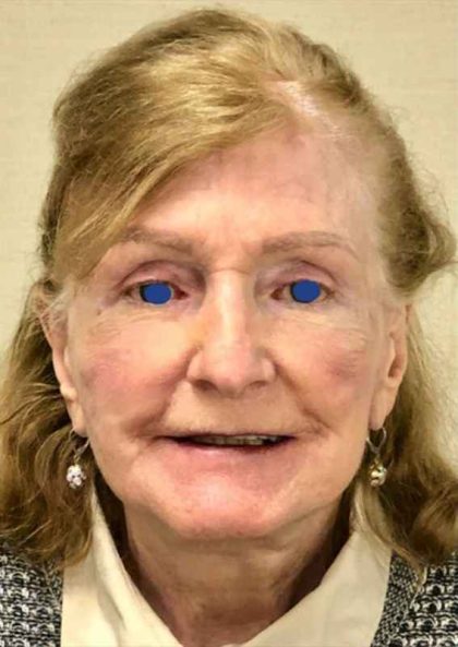 Facelift Before & After Patient #930