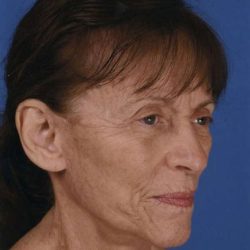 Facelift Before & After Patient #933