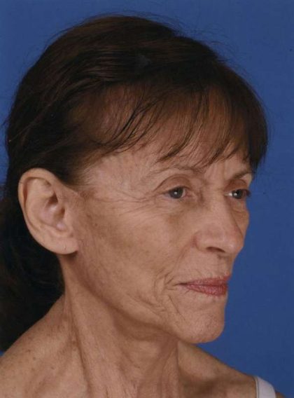 Facelift Before & After Patient #933