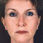 Facelift Before & After Patient #939