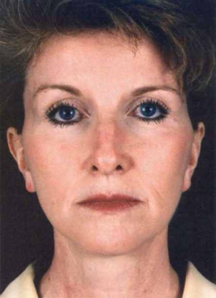 Facelift Before & After Patient #939