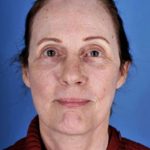 Facelift Before & After Patient #945