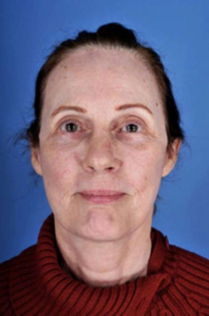 Facelift Before & After Patient #945