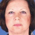 Facelift Before & After Patient #957