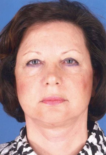 Facelift Before & After Patient #957