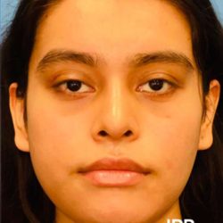 Facial Feminization Before & After Patient #882