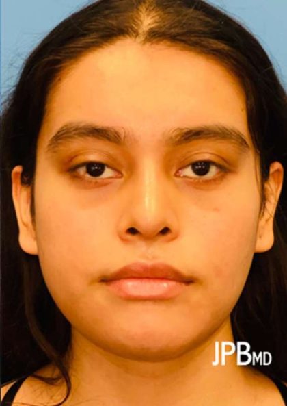 Facial Feminization Before & After Patient #882