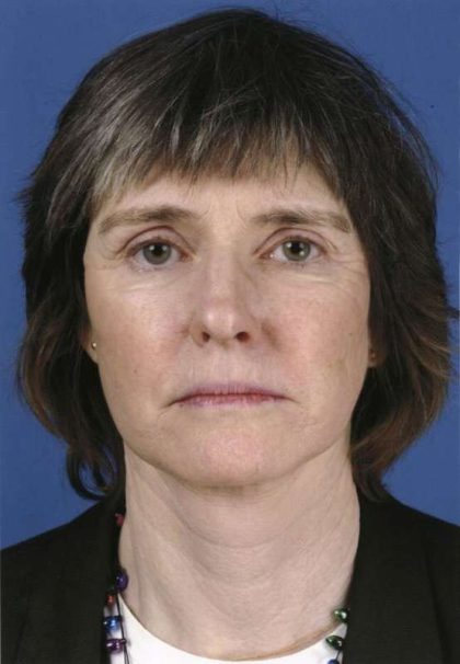 Facelift Before & After Patient #963