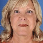 Facelift Before & After Patient #969