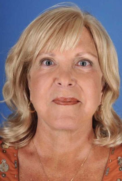 Facelift Before & After Patient #969