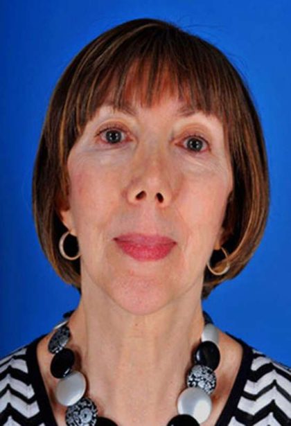 Facelift Before & After Patient #975