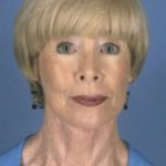 Facelift Before & After Patient #987