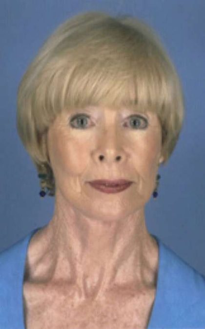 Facelift Before & After Patient #987
