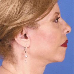 Facelift Before & After Patient #999
