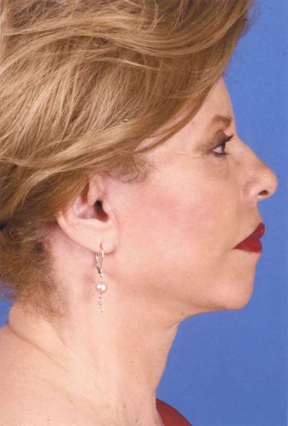 Facelift Before & After Patient #999