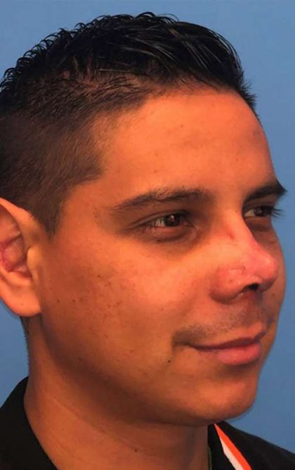 Rhinoplasty Before & After Patient #1005