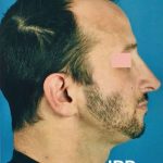 Rhinoplasty Before & After Patient #1017