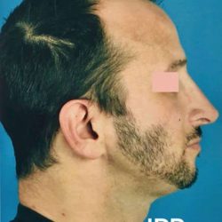 Rhinoplasty Before & After Patient #1017