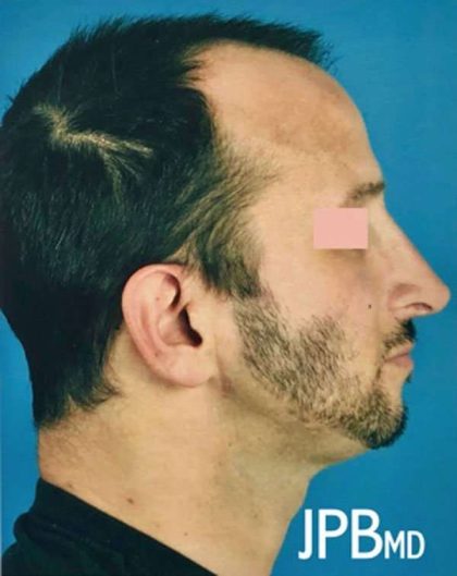 Rhinoplasty Before & After Patient #1017