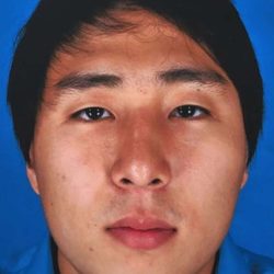 Rhinoplasty Before & After Patient #1023