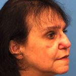 Rhinoplasty Before & After Patient #1026