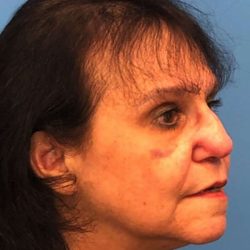Rhinoplasty Before & After Patient #1026
