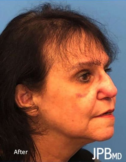 Rhinoplasty Before & After Patient #1026
