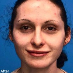 Rhinoplasty Before & After Patient #1038