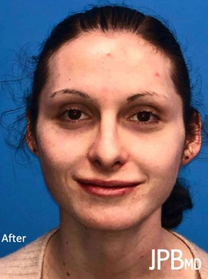Rhinoplasty Before & After Patient #1038
