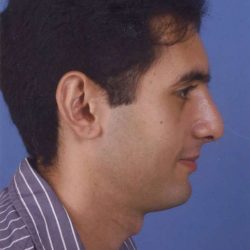 Rhinoplasty Before & After Patient #1047
