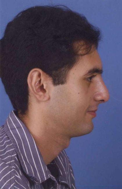 Rhinoplasty Before & After Patient #1047