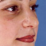 Rhinoplasty Before & After Patient #1050