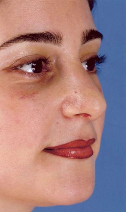 Rhinoplasty Before & After Patient #1050