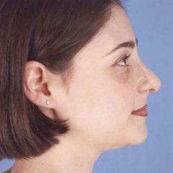 Rhinoplasty Before & After Patient #1053