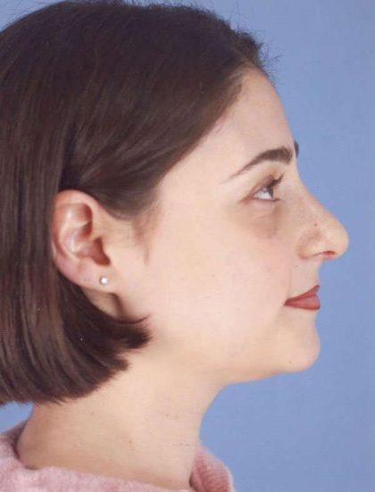 Rhinoplasty Before & After Patient #1053