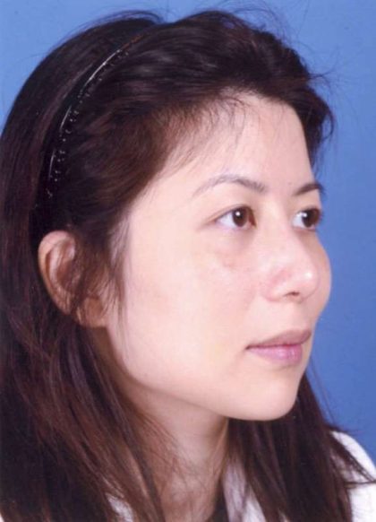 Rhinoplasty Before & After Patient #1065