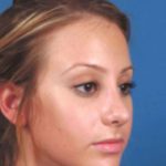 Rhinoplasty Before & After Patient #1077
