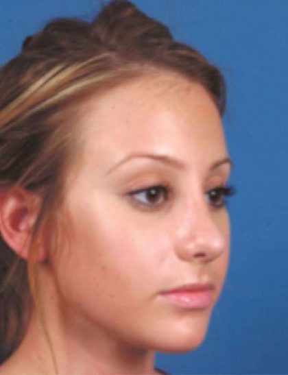 Rhinoplasty Before & After Patient #1077