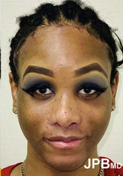 Facial Feminization Before & After Patient #894