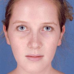 Rhinoplasty Before & After Patient #1092