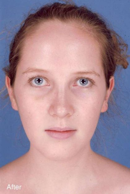 Rhinoplasty Before & After Patient #1092
