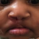 Cleft Lip Before & After Patient #1101