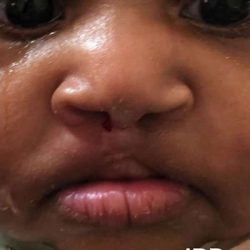 Cleft Lip Before & After Patient #1101
