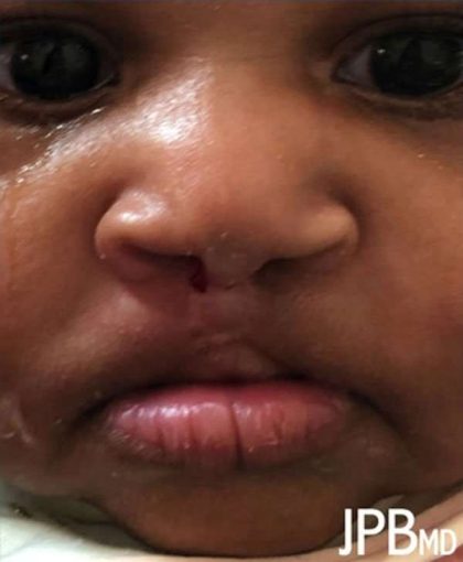 Cleft Lip Before & After Patient #1101