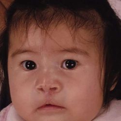 Cleft Lip Before & After Patient #1104