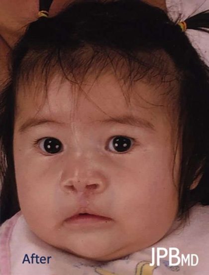 Cleft Lip Before & After Patient #1104