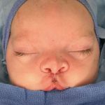 Cleft Lip Before & After Patient #1107