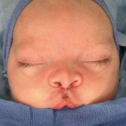 Cleft Lip Before & After Patient #1107