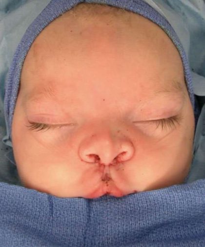 Cleft Lip Before & After Patient #1107