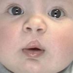 Cleft Lip Before & After Patient #1110